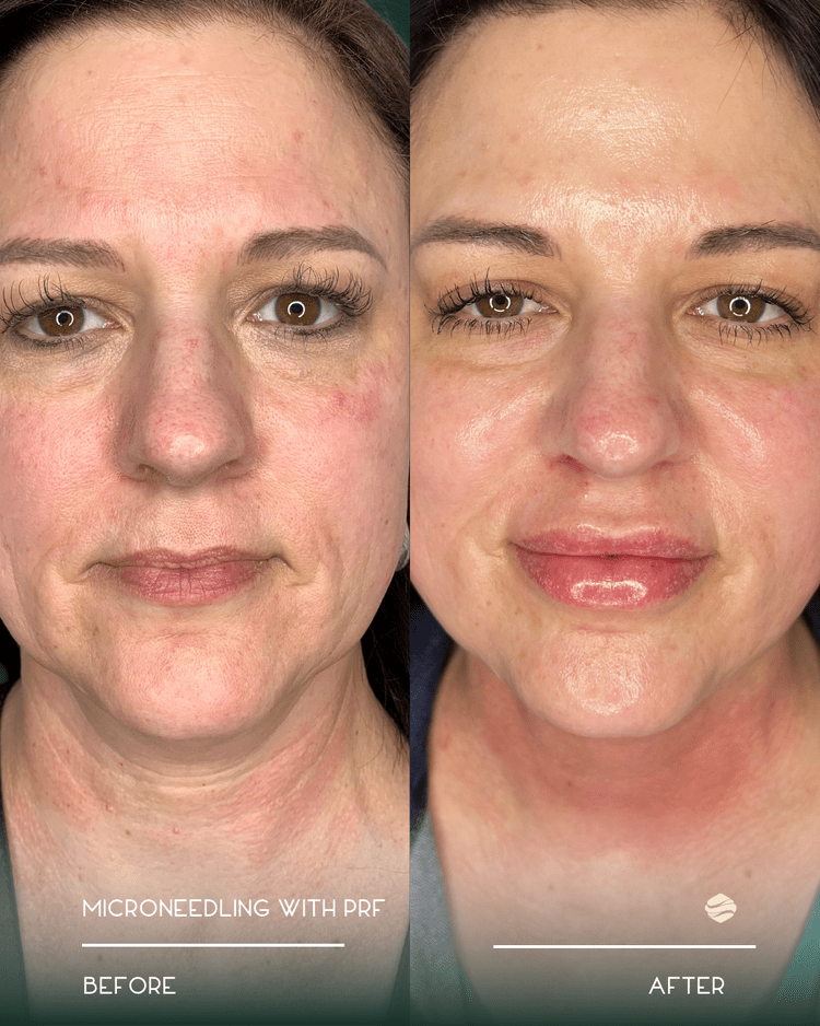 Before and after results of Microneedling with PRF at Zinovations in Milton, GA