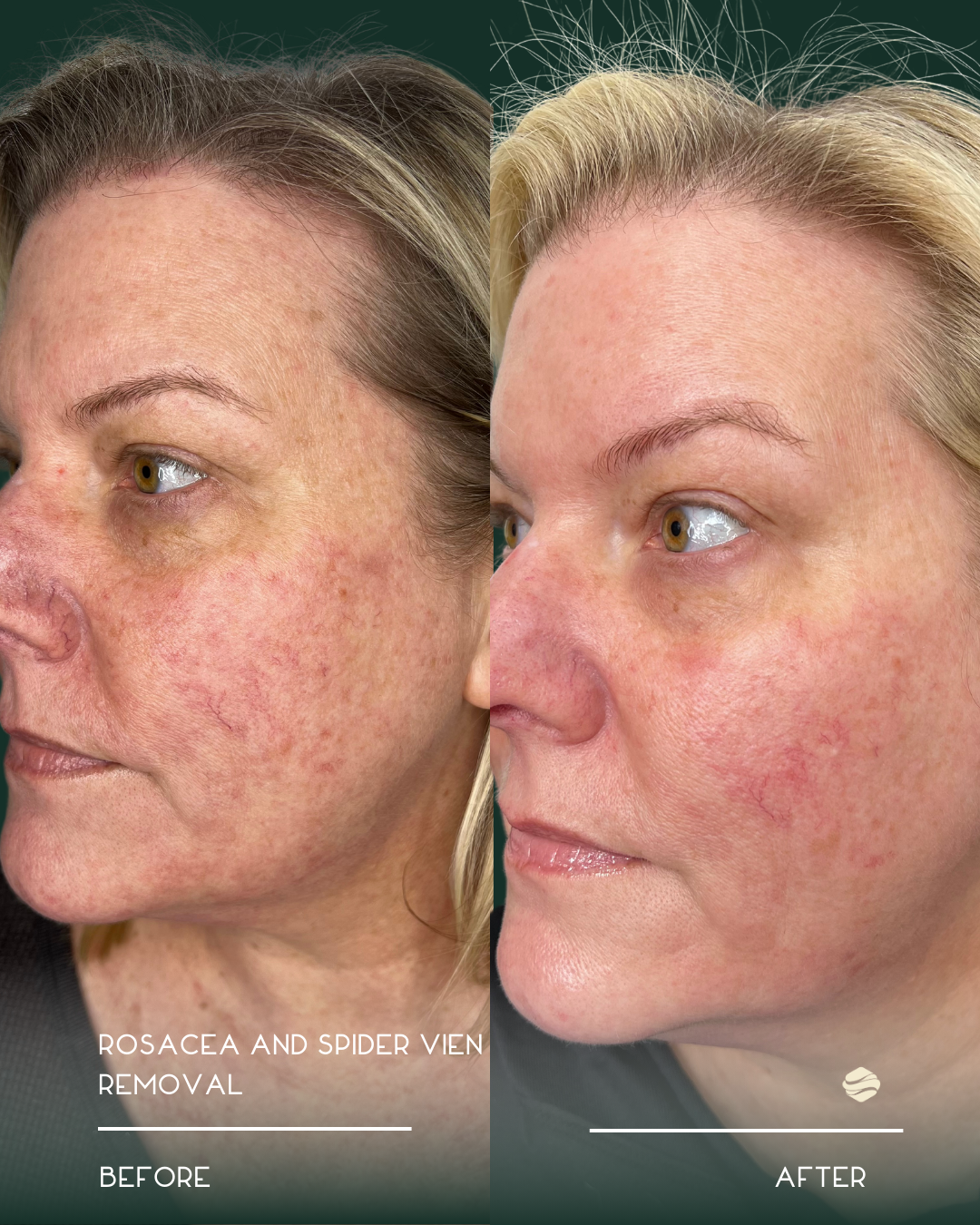 Side-by-side comparison showing a woman's face before and after rosacea and spider vein removal treatment. The left side labeled 'Before' displays redness, visible blood vessels, and uneven skin texture. The right side labeled 'After' shows a clearer