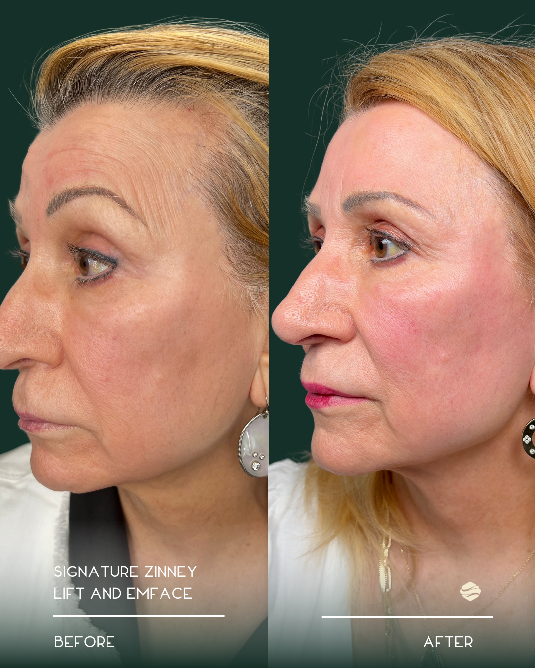 Before and after images of a woman showing facial skin improvements following a lift and emface treatment by Signature Zinney.
