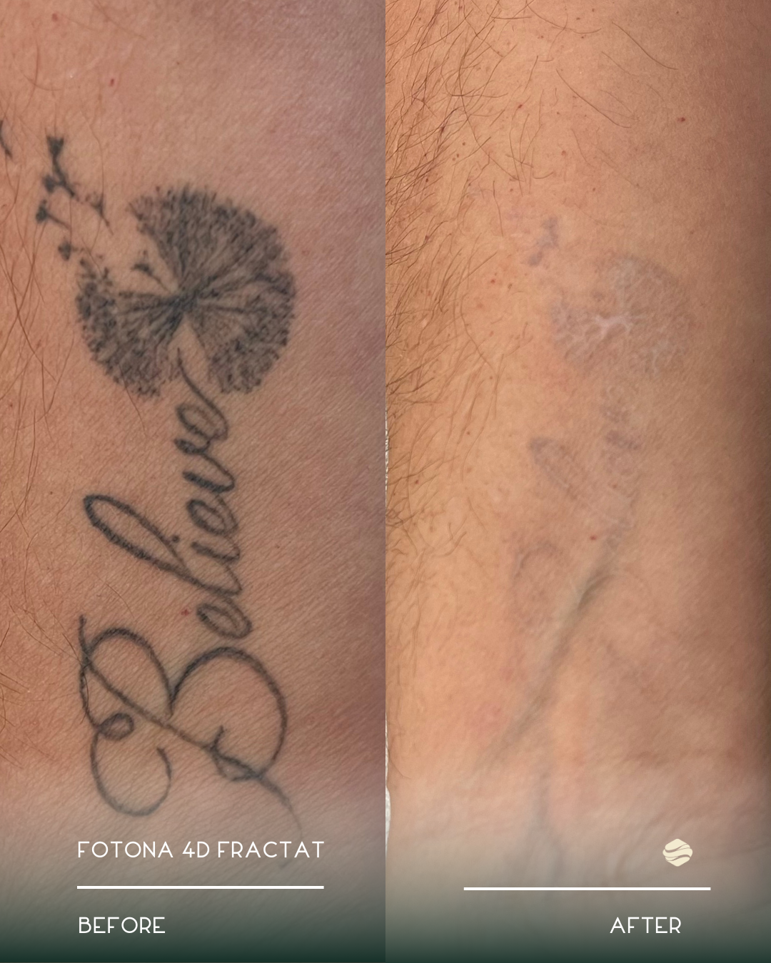 Comparison of a tattoo before and after removal. The tattoo features a flower with the word 'Blessed' written beneath it.