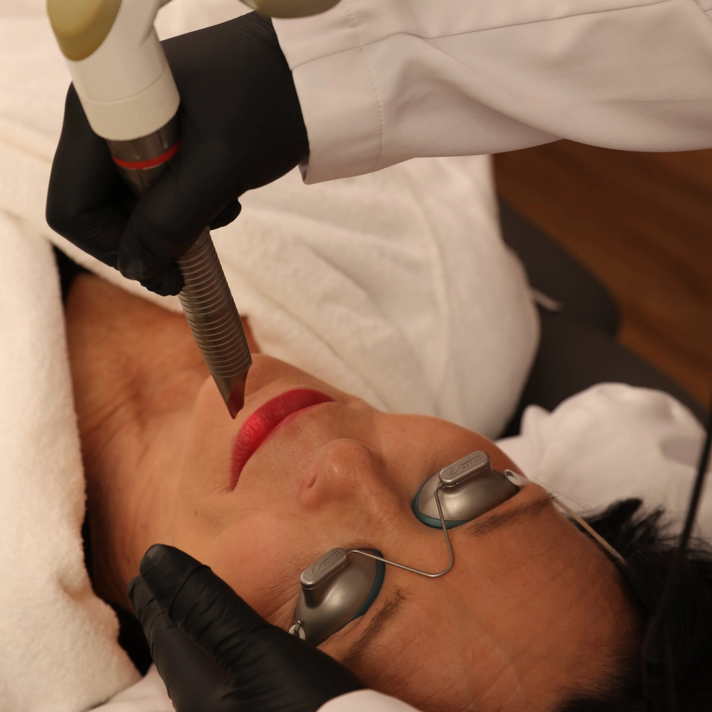 Fotona LipLase® Lip Enhancement
