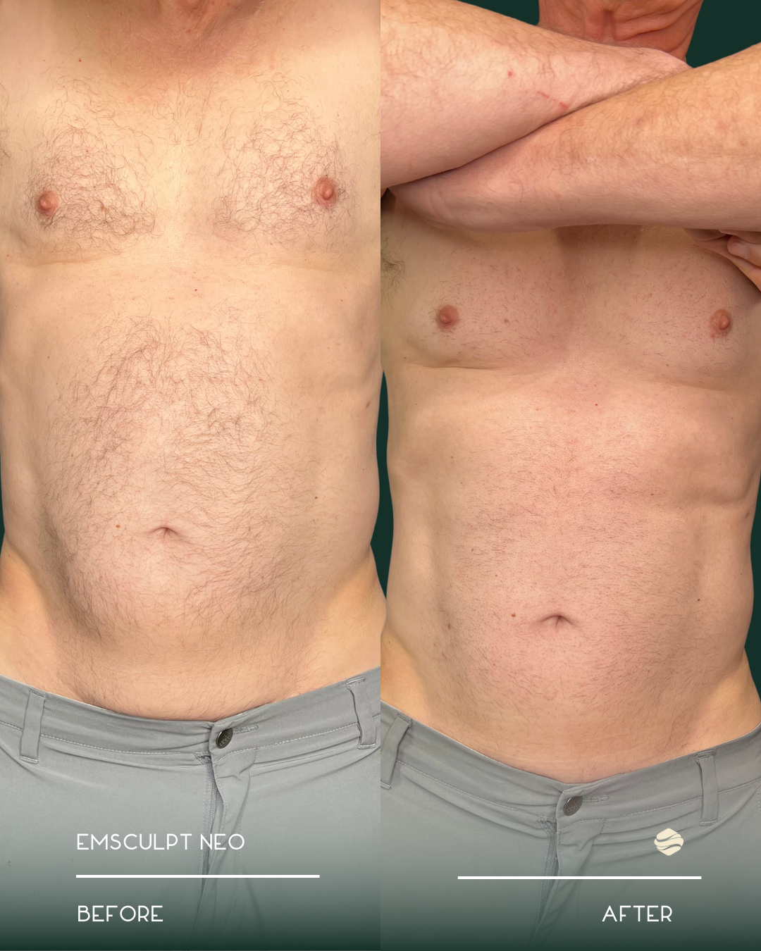 Side-by-side comparison of a man's bare torso before and after a body transformation. The 'before' side shows more body hair and less muscle definition, while the 'after' side shows a more toned and lean appearance with less hair.