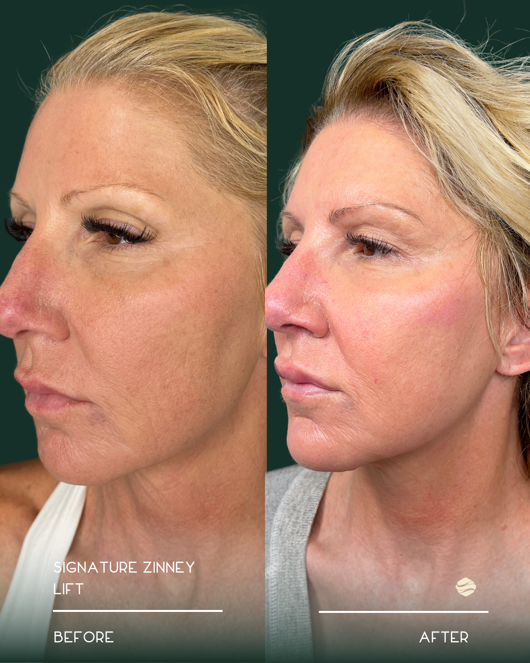 Before and after photos of a woman showing the results of a Signature Zinney Lift procedure, with the left side labeled 'Before' and the right side labeled 'After.'