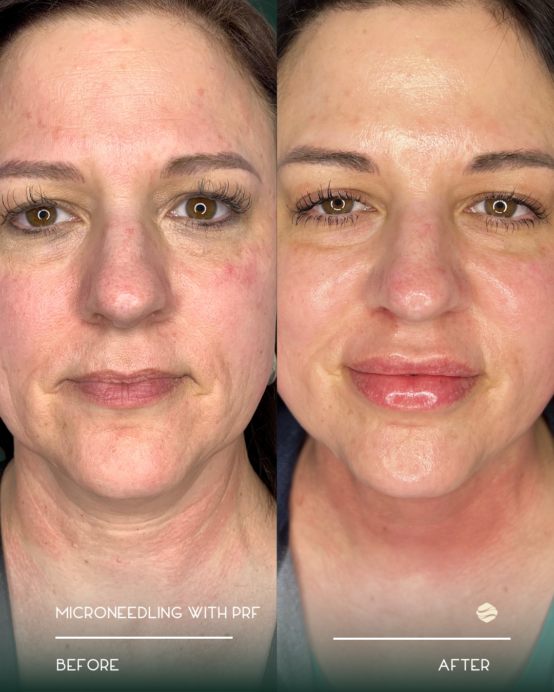 Comparison of a woman's face before and after microneedling treatment. The left side shows redness and uneven skin texture, while the right side shows smoother, more even skin with less redness.