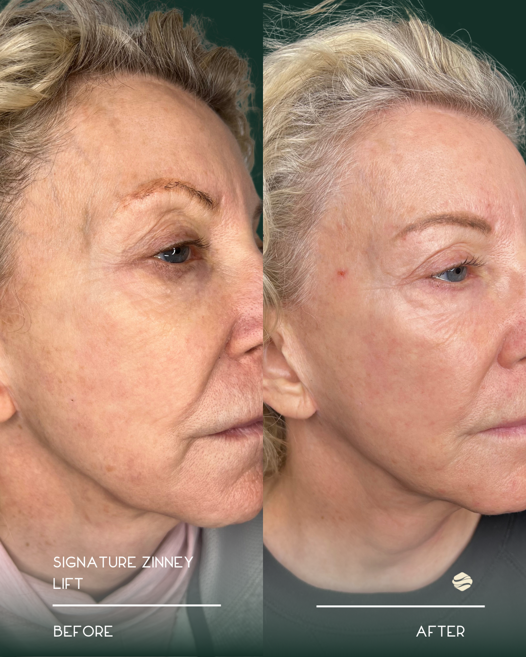 Side-by-side comparison photo showing a woman's face before and after a skin treatment. The left side labeled 'Before' shows more wrinkles and uneven skin texture. The right side labeled 'After' shows smoother skin with fewer wrinkles and a more even