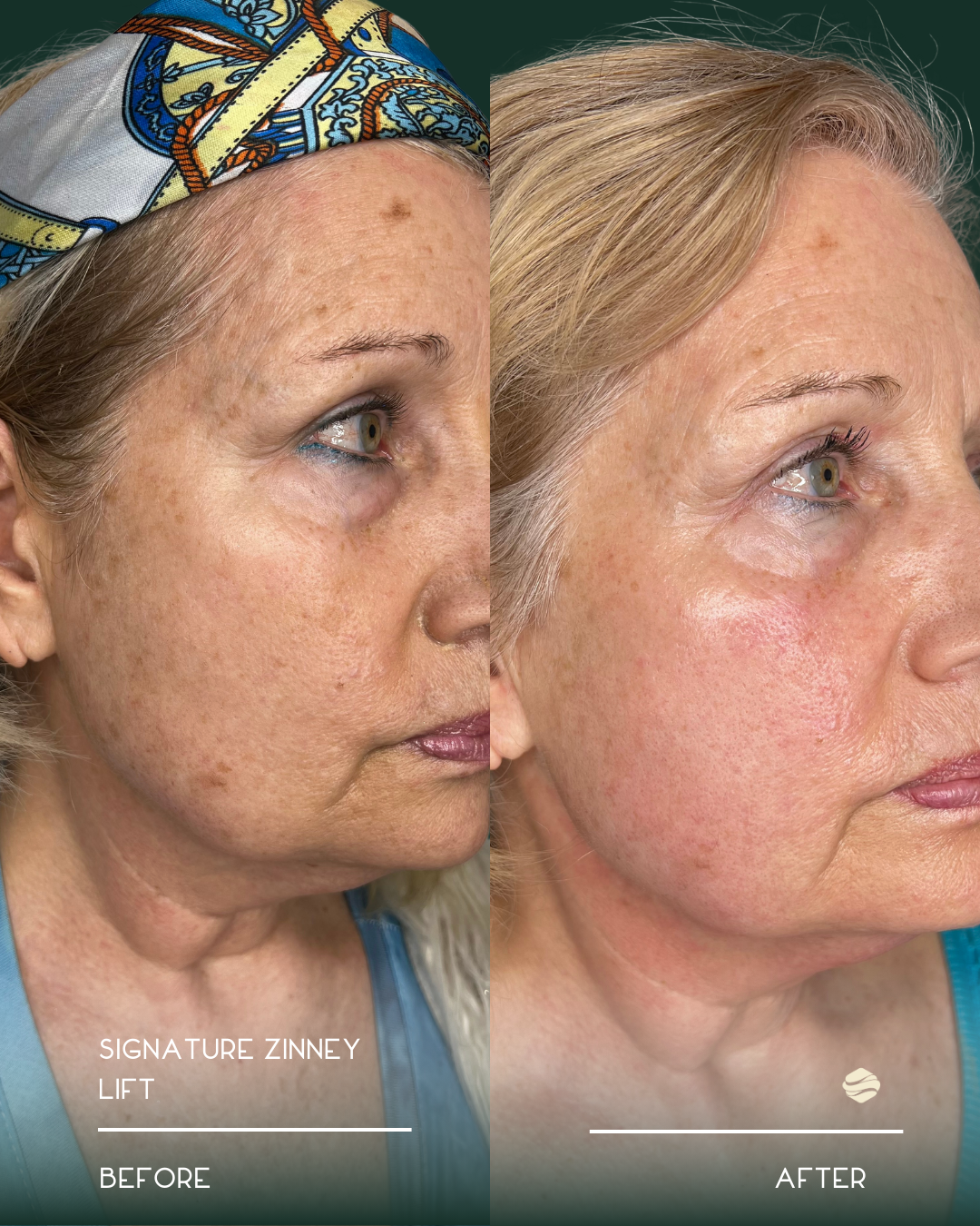 Side-by-side comparison of a woman's face showing skin improvement after a skin treatment. Left side labeled 'Before,' right side labeled 'After.'