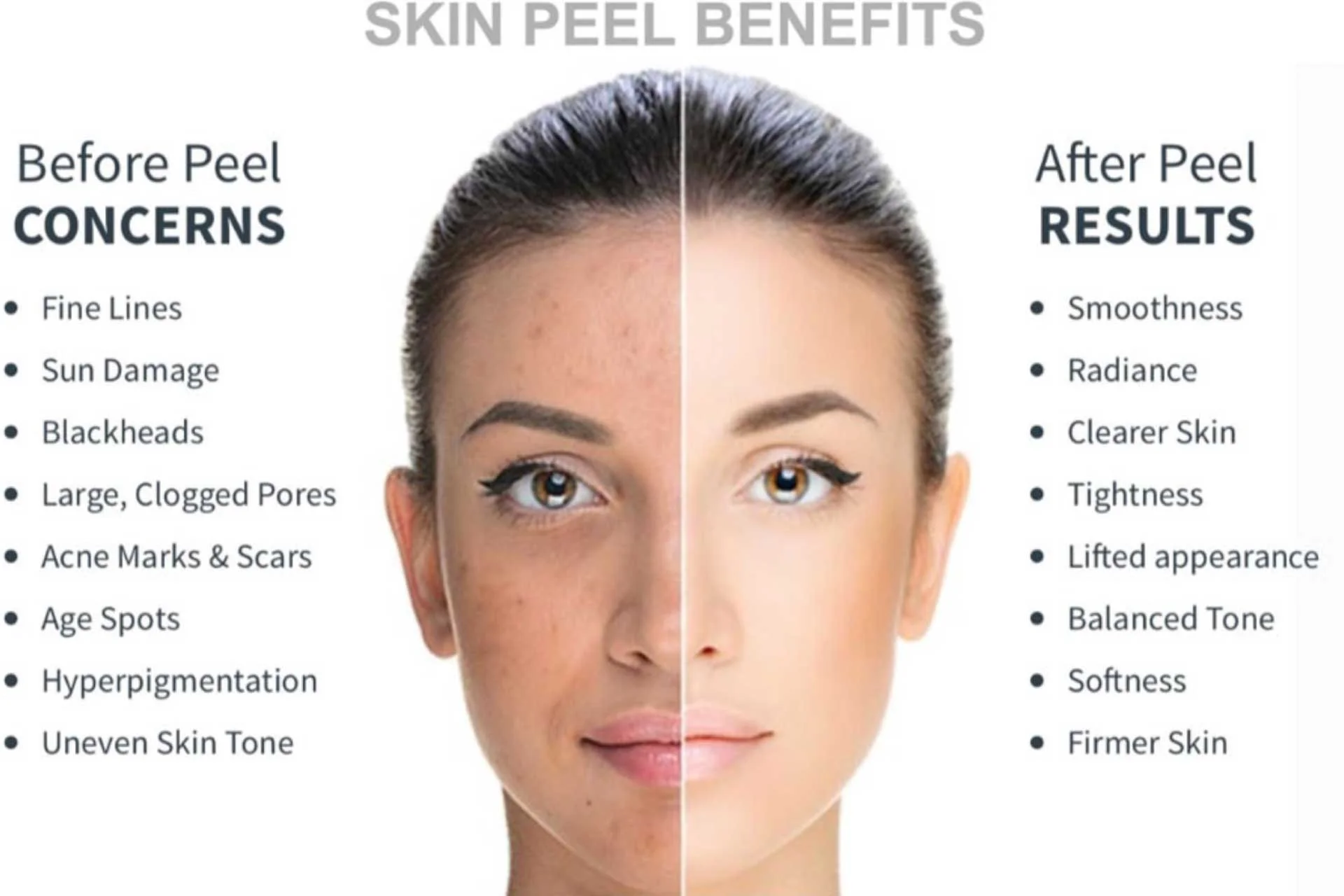 Comparison of a woman's face before and after a skin peel treatment showing improved skin condition and benefits listed beside each side. Before peel side has concerns including fine lines, sun damage, blackheads, large pores, acne scars, age spots, hyperpigmentation, uneven skin tone. After peel side displays benefits such as smoothness, radiance, clearer skin, tightness, a lifted appearance, balanced tone, softness, and firmer skin.