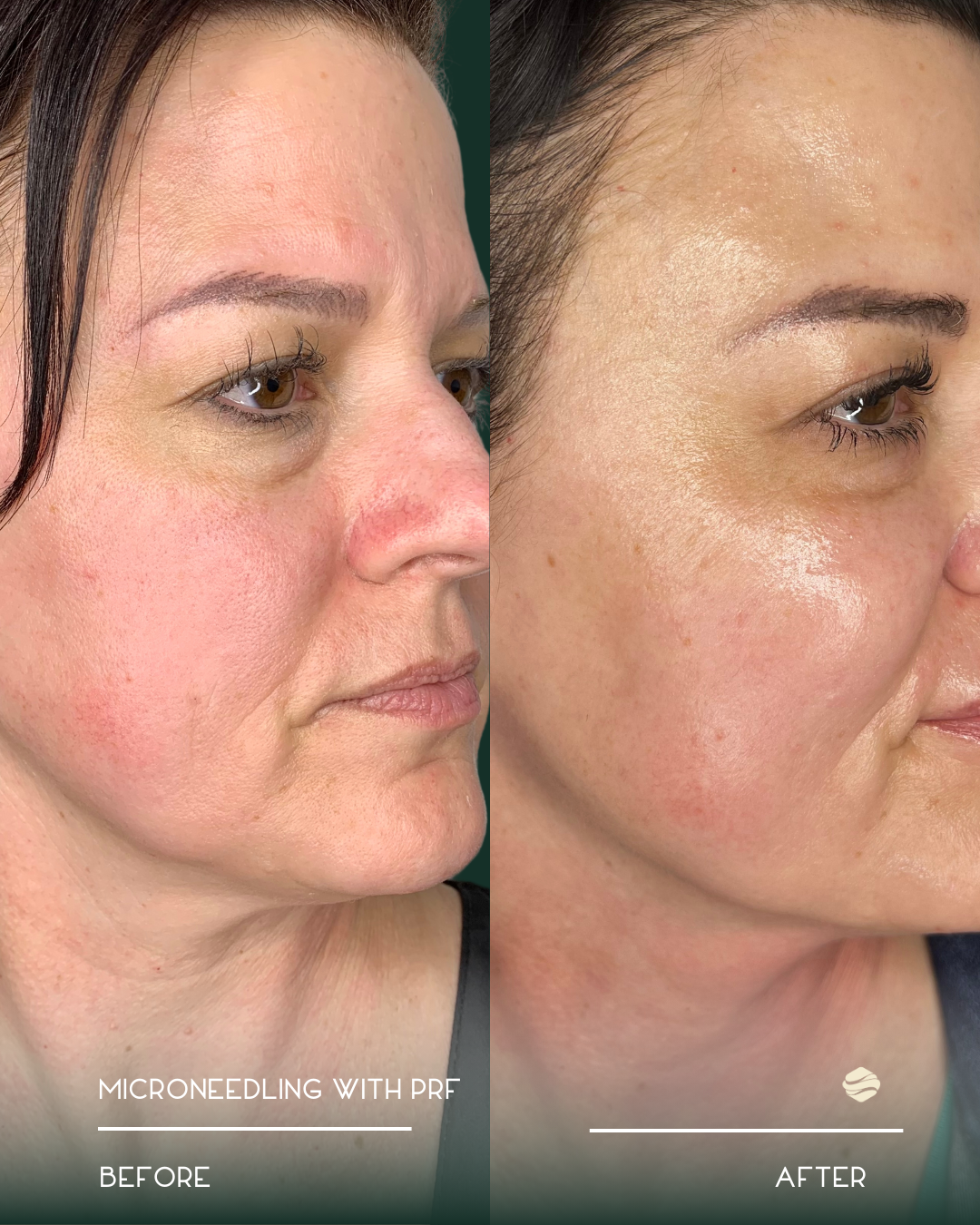 Side-by-side comparison of a woman's face before and after microneedling with PRF, showing improved skin texture and reduced redness.