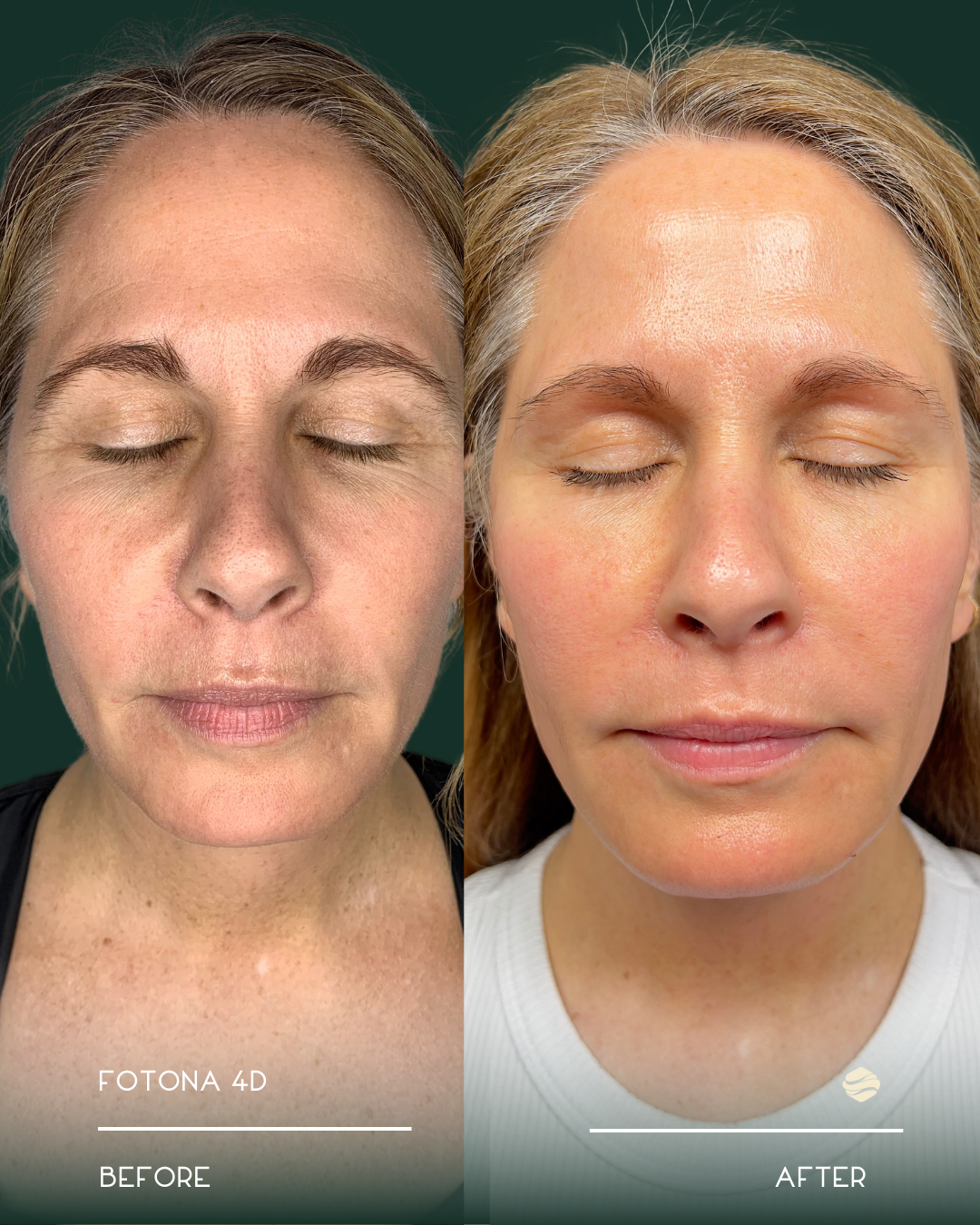 Side-by-side comparison of a woman's face before and after a skincare treatment, showing improved skin tone and texture.