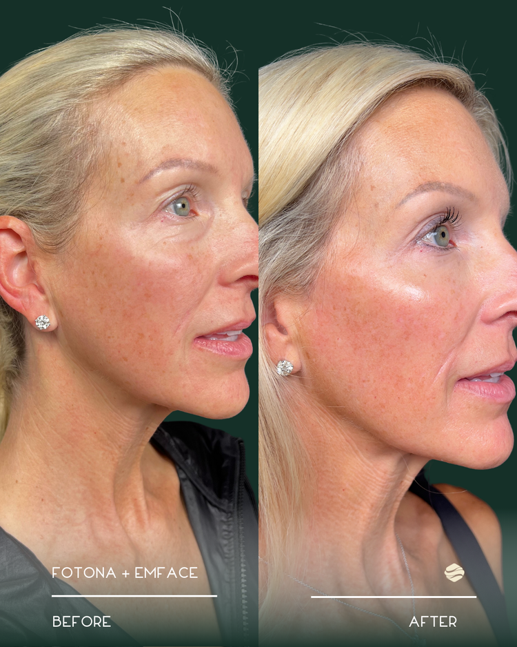 Emface Before and After Result 2
