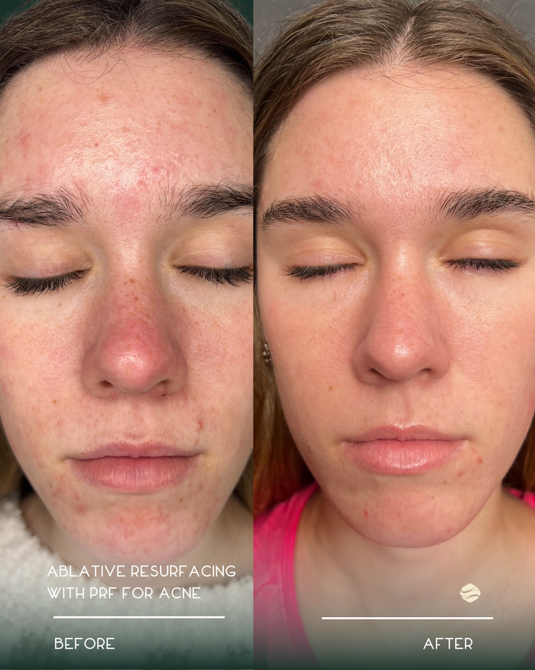 Before and after results of Ablative Resurfacing with PRF for Acne at Zinovations in Milton, GA