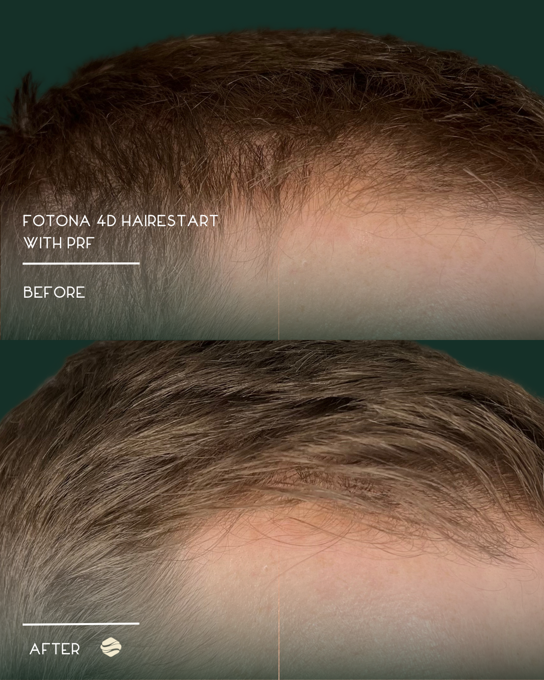 Comparison of hair before and after using Fotona 4D hair restoration treatment with PRF, showing increased hair density and improved appearance.