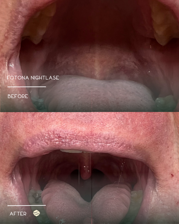 Before and after results of Fotona NightLase at Zinovations in Milton, GA