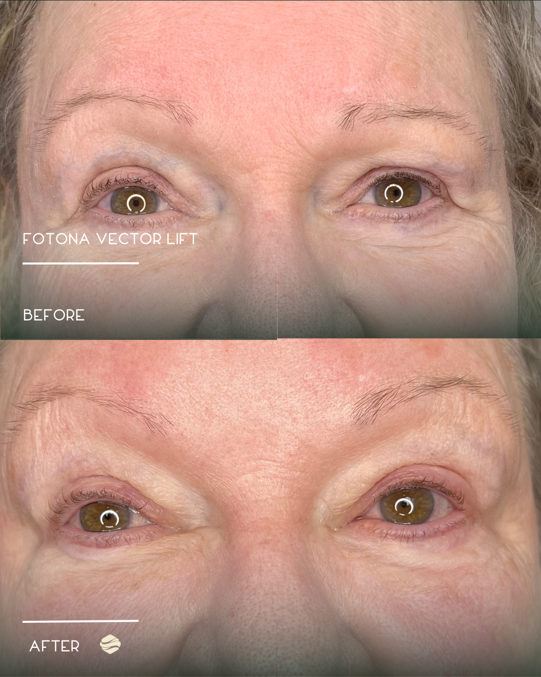 Close-up of a woman's eyes showing the before and after results of a Fotona Vector Lift treatment, with visible skin tightening and reduced wrinkles around the eyes.