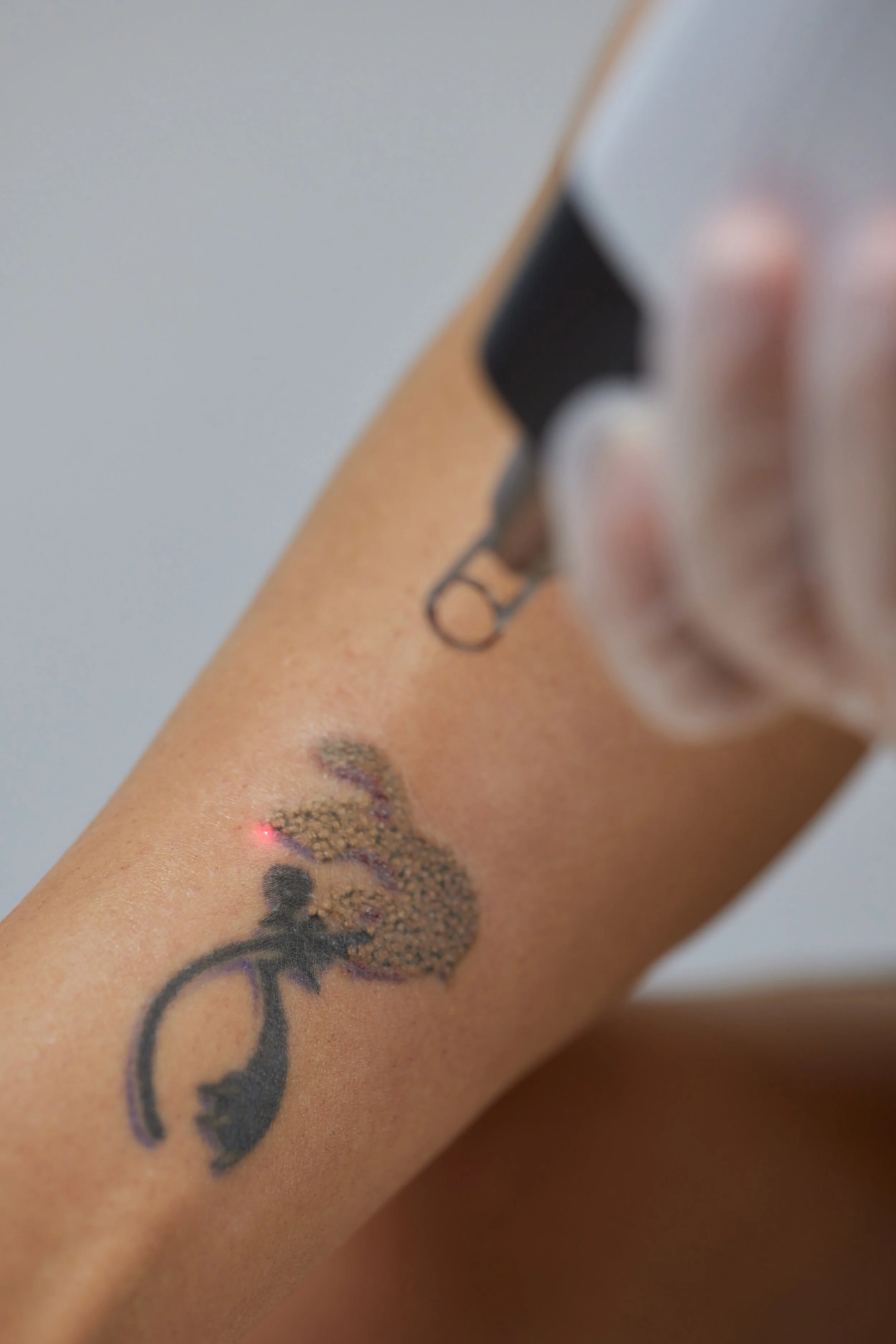 Close-up of a tattoo being laser removed from a person's arm.