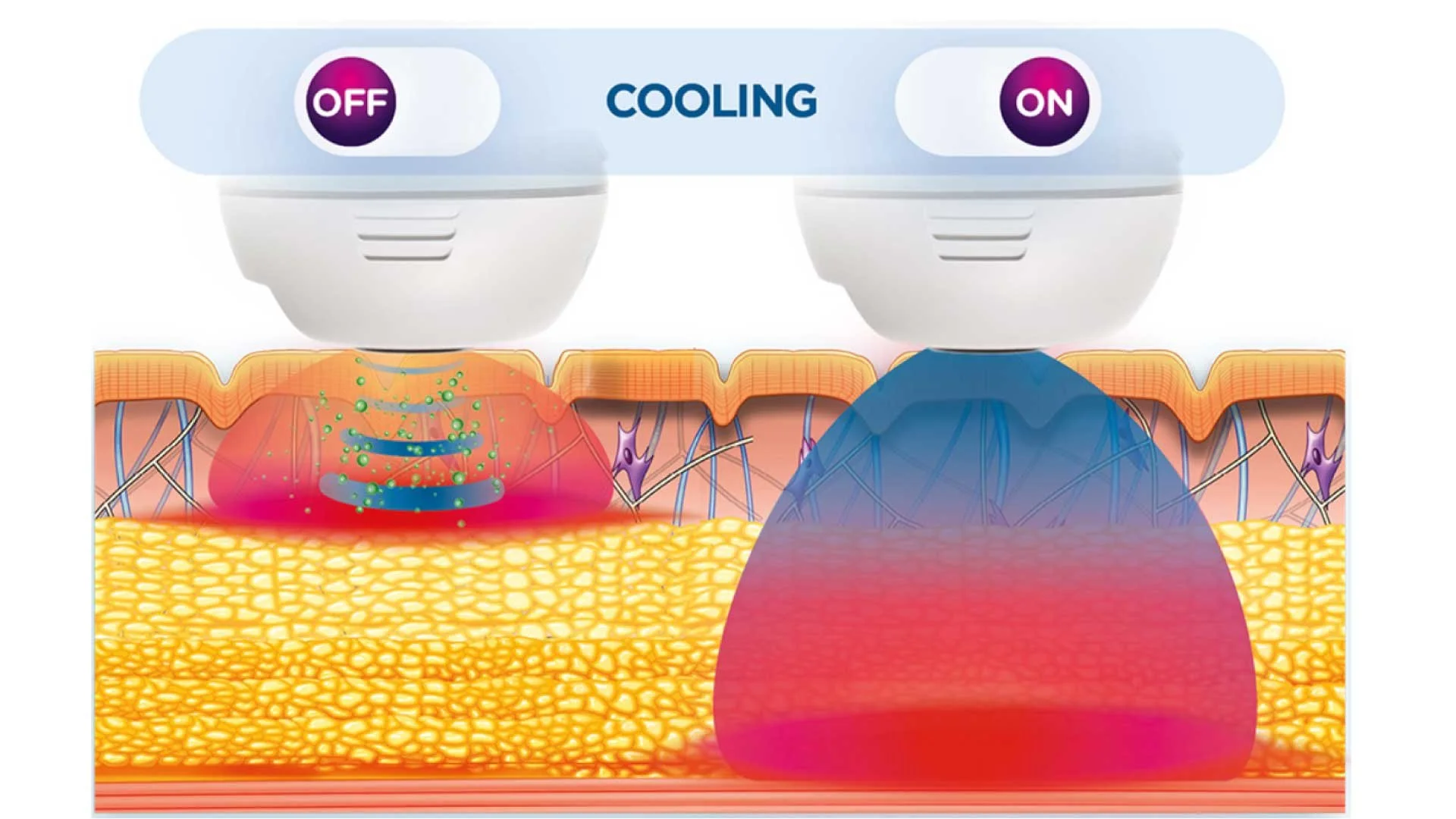 Diagram showing two skin temperature control devices with switches labeled 'OFF' and 'ON', and the word 'COOLING' in the middle, above a cross-section of skin with underlying tissues.