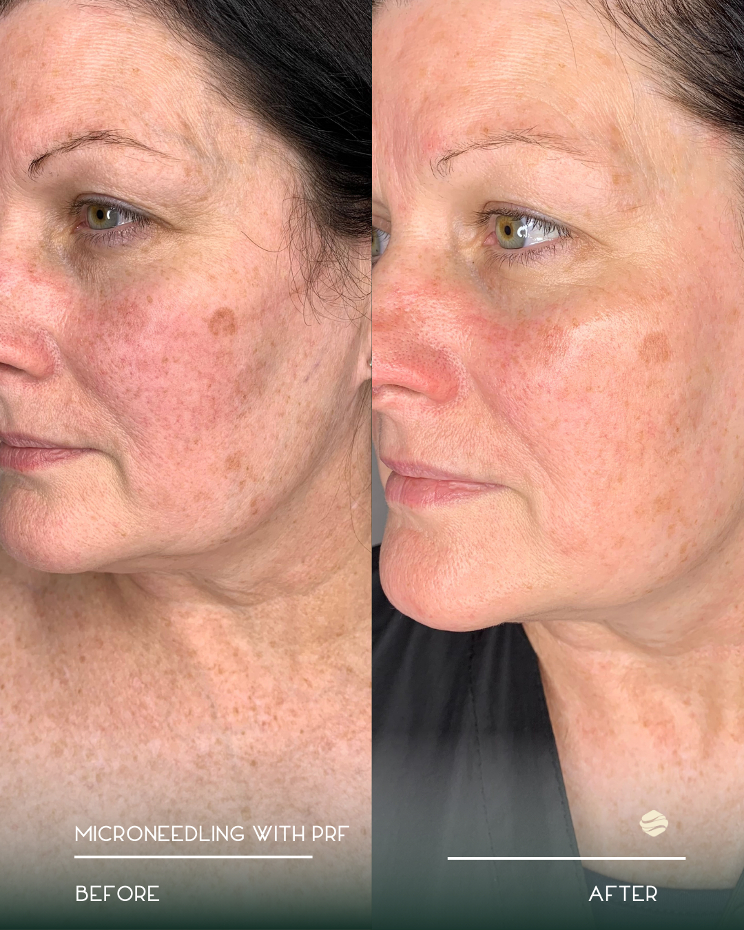 Side-by-side comparison of a woman's face before and after microneedling with PRF treatment, showing improved skin texture, reduced redness, and minimized dark spots.