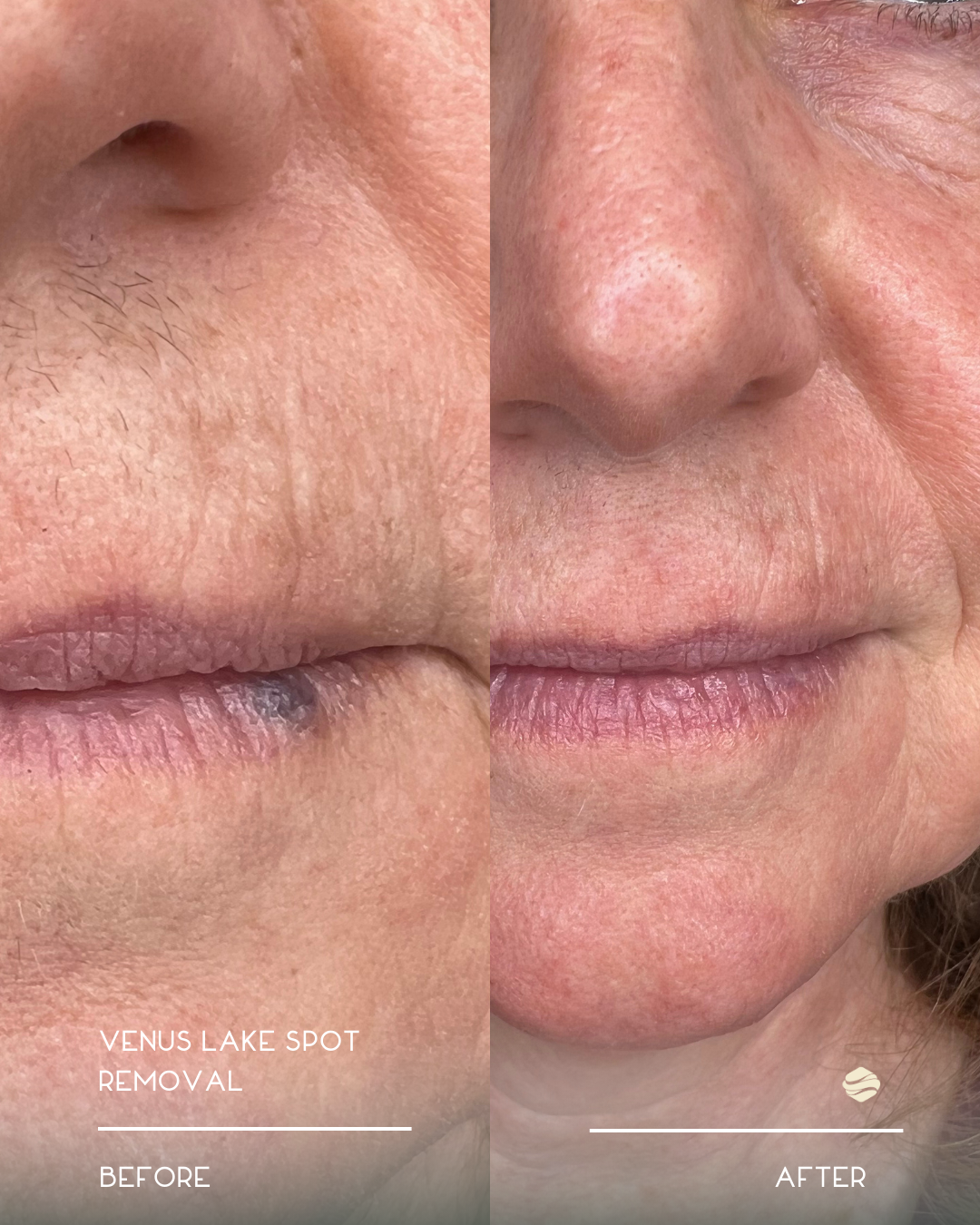 Side-by-side comparison of a person's face showing a before and after of Venus Lake Spot removal treatment, highlighting clear skin improvements, especially around the lips and nose area.