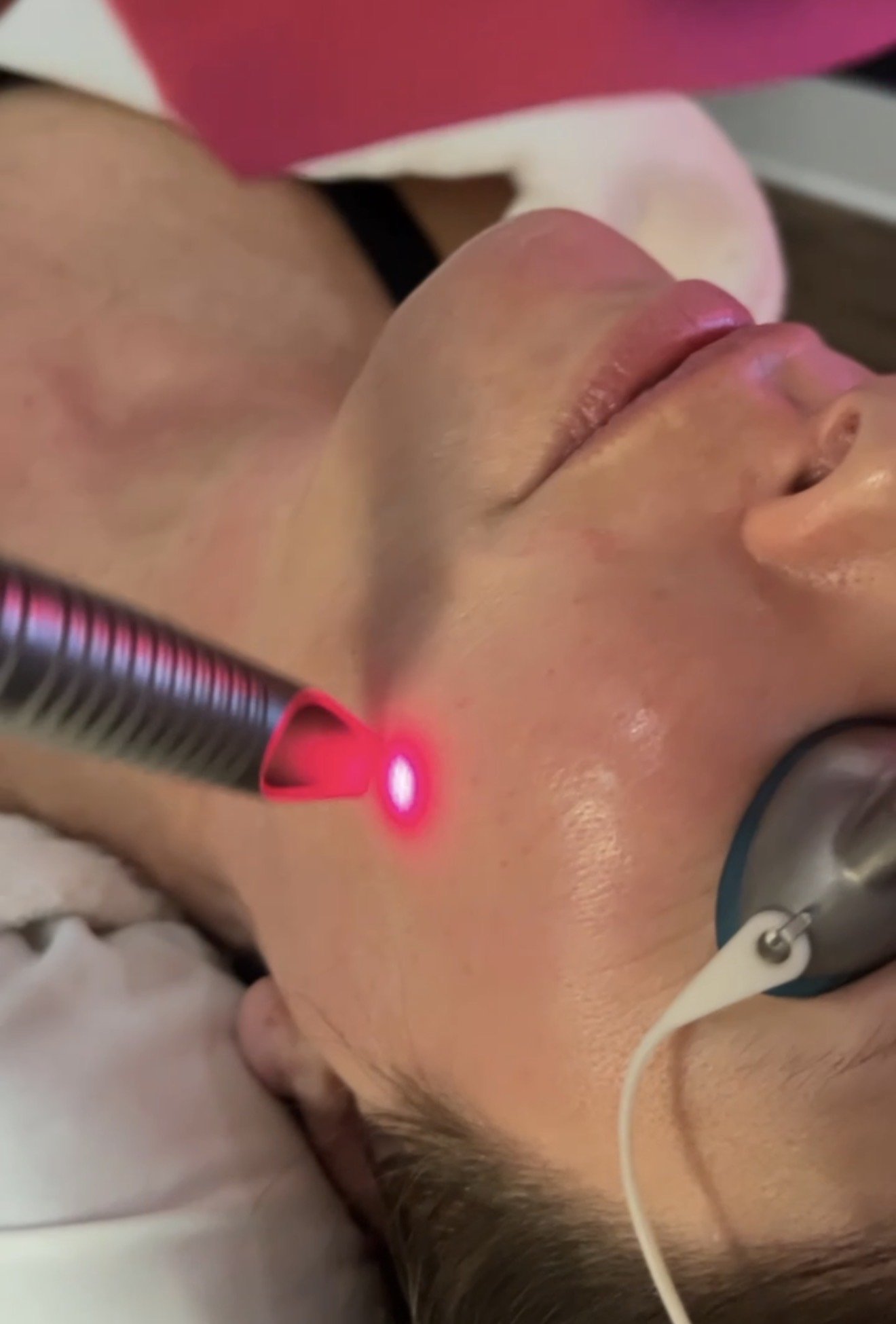 Cool Laser Peel