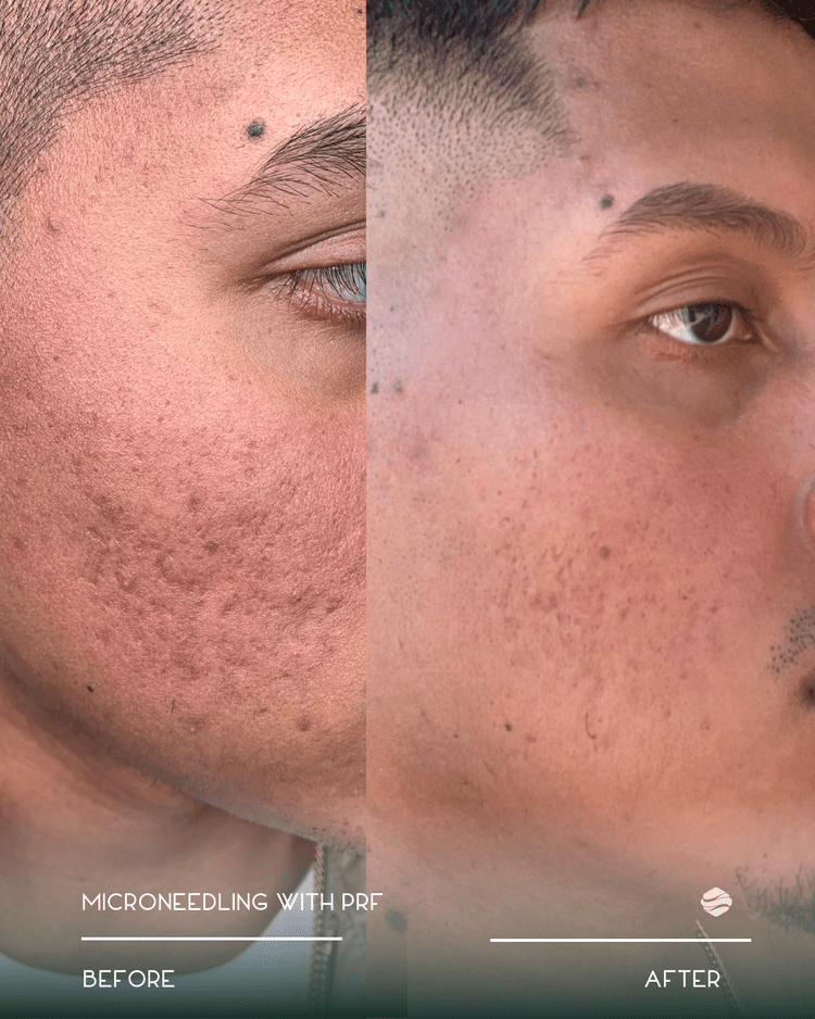 Before and after results of Microneedling with PRF at Zinovations in Milton, GA
