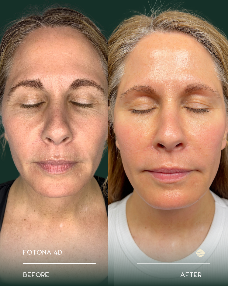 Fotona 4D Before and After 2