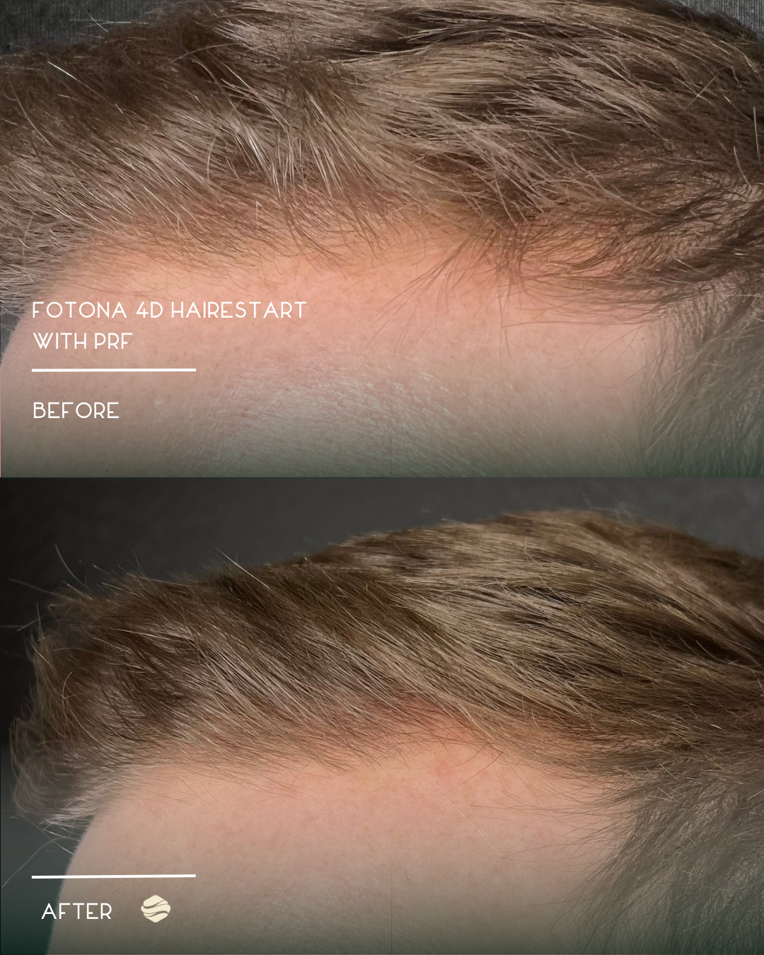 Before and after photos of a man's scalp showing improved hair density following a 4D hair transplant with PRF, with visible increased hair coverage and healthier appearance.