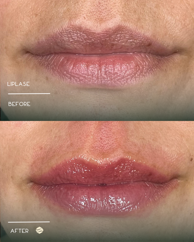 Before and after results of LipLase at Zinovations in Milton, GA