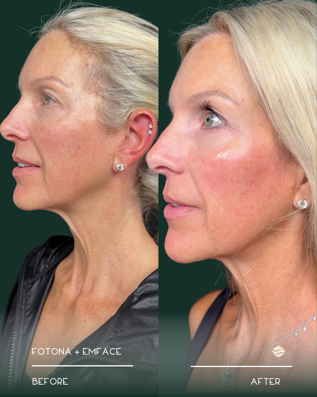 Side-by-side comparison of a woman before and after facial treatment. The before image shows her with uneven skin tone and fine lines, while the after image shows smoother skin with improved texture and overall appearance.