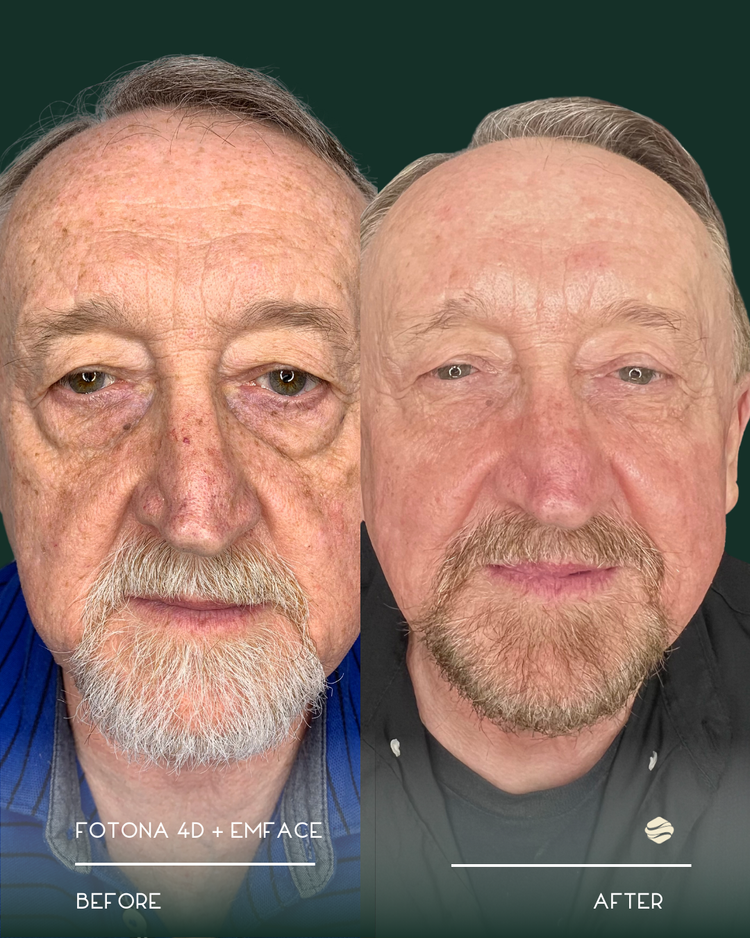 Emface Before and After Result 3
