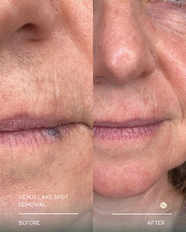 Before and after results of Laser Age Spot Removal at Zinovations in Milton, GA