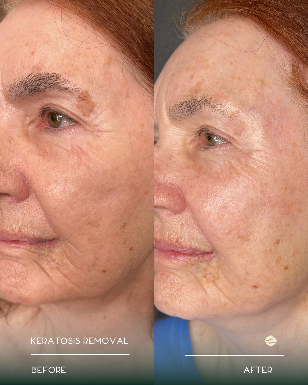 Side-by-side comparison of a woman's face showing before and after keratosis removal, highlighting reduced skin keratosis and clearer complexion.