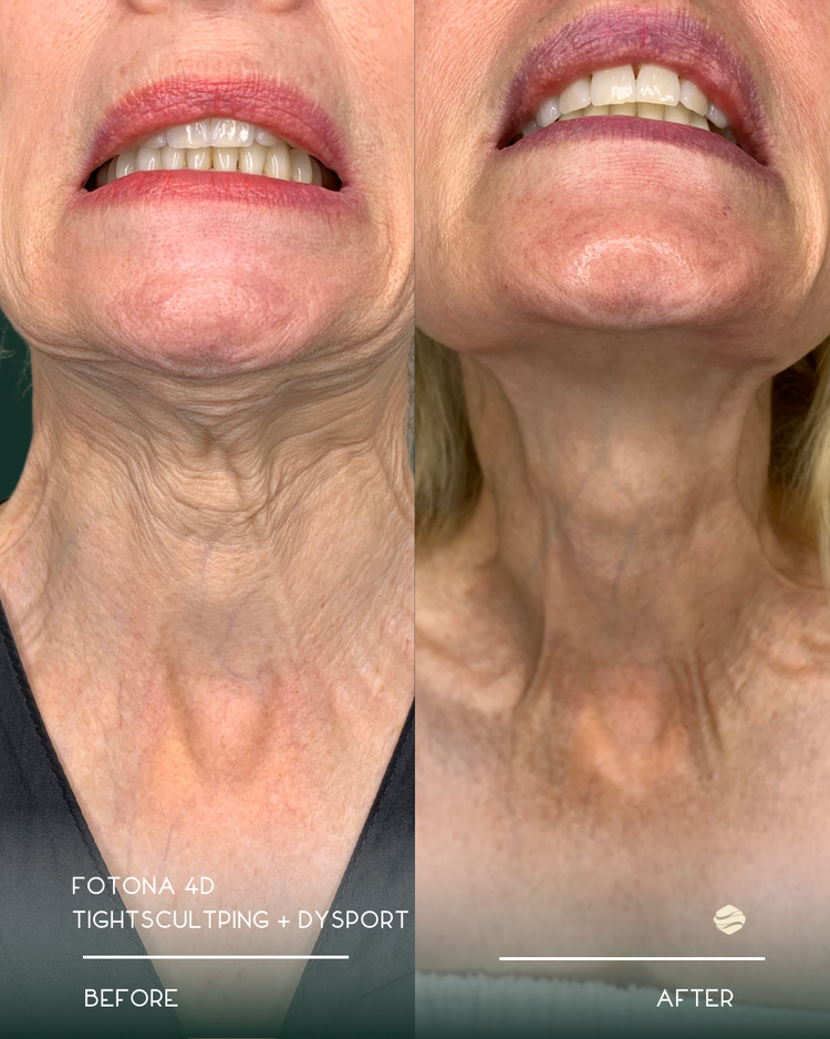 Before and after results of Fotona 4D Tightening + Dysport at Zinovations in Milton, GA