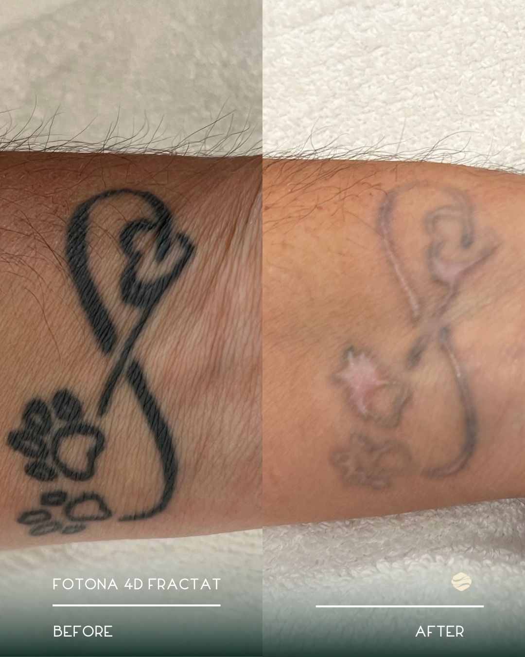 Comparison of a tattoo before and after laser removal. The tattoo is a black ink design of a heart with a bow, partially faded in the after image.