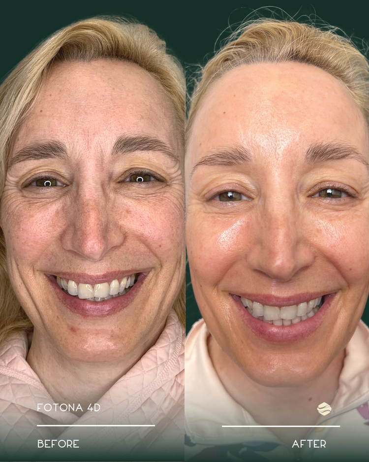 Fotona 4D Before and After 1