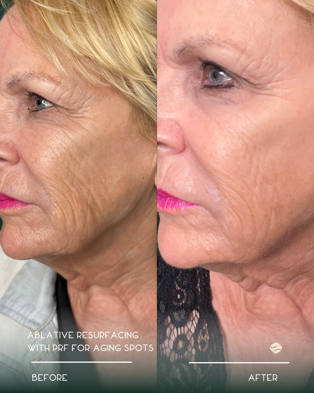 Close-up side view of an elderly woman's face showing before and after images of ablative resurfacing treatment with PRF to reduce aging spots. The before image has more visible wrinkles and pigmentation, while the after image shows smoother skin wit