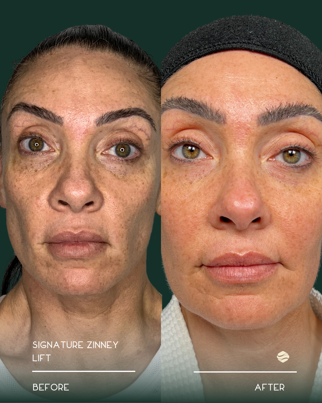 Side-by-side comparison of a woman's face before and after a skin treatment, showing reduced freckles, dark spots, and smoother skin post-treatment.