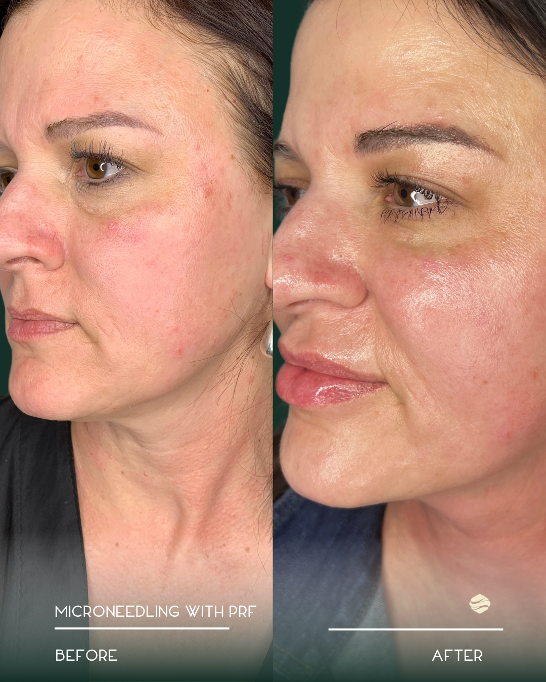 Side-by-side comparison of a woman's face showing before and after microneedling with PRF treatment, highlighting improved skin texture and reduced redness.