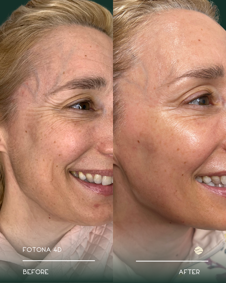 Fotona 4D Before and After 3