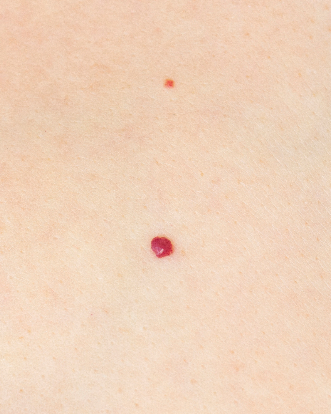 Cherry Angioma Removal