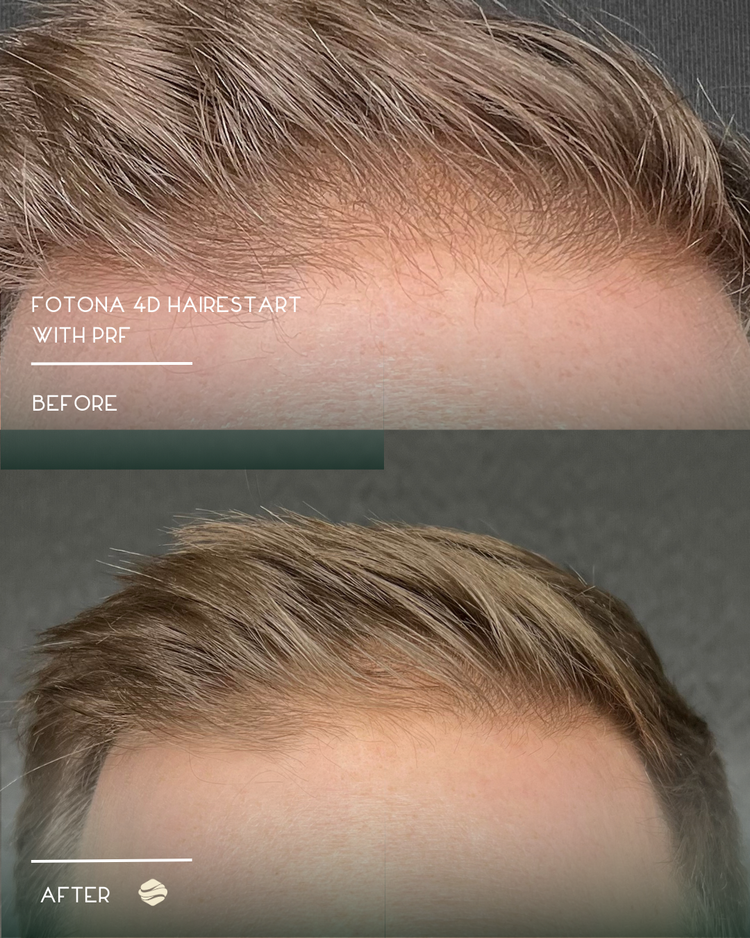 Before and after results of Fotona 4D HairStart with PRF at Zinovations in Milton, GA