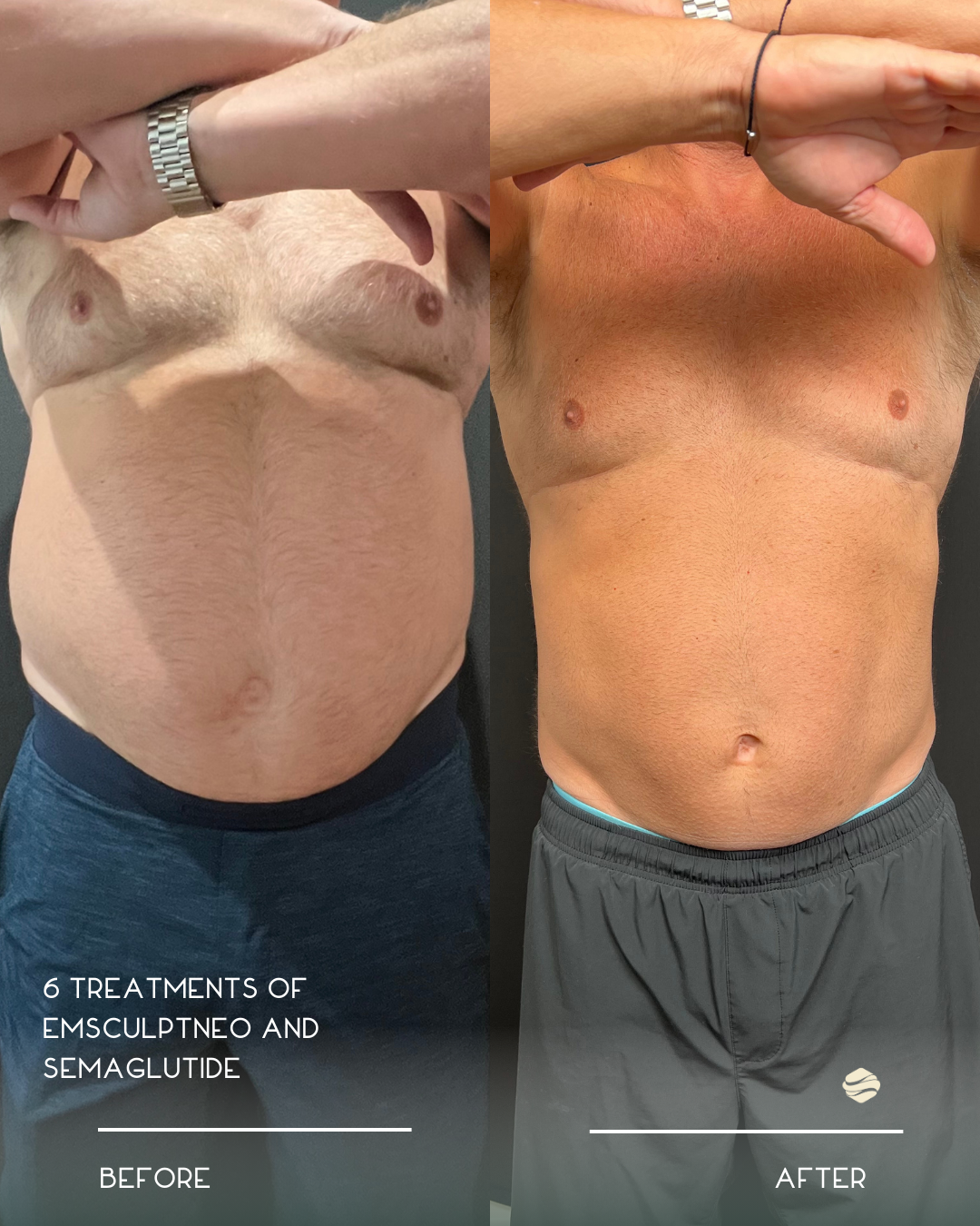 Comparison photo of a man's torso showing before and after results of six treatments of EMSCULPT Neo and Semaglutide. The left shows the before, with less muscle definition and more abdominal fat. The right shows the after, with more muscular definit
