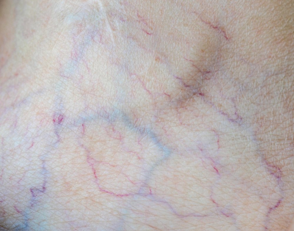 Spider Vein Treatments
