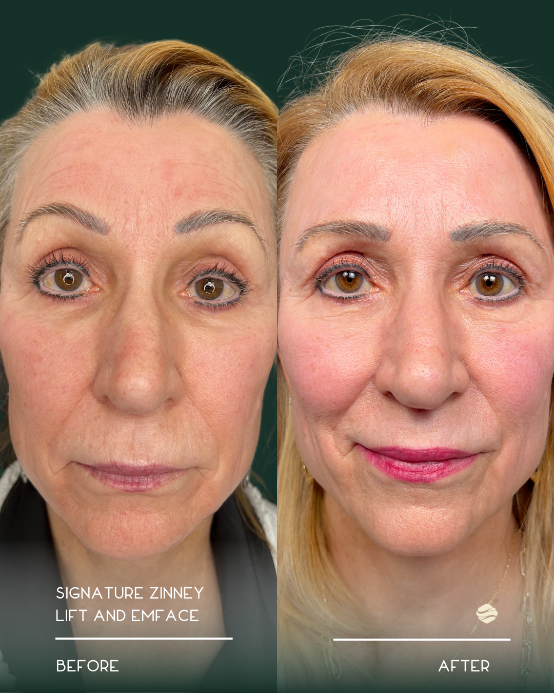 Side-by-side comparison of a woman's face before and after a facelift and EMFACE treatment, showing reduced wrinkles and a more youthful appearance.