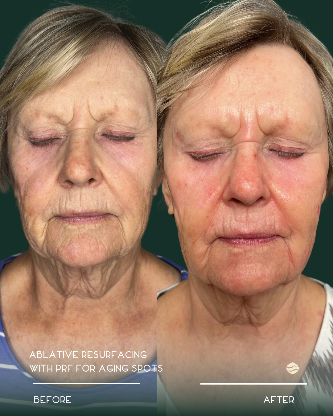 Side-by-side comparison of an elderly woman's face showing the effects of ablative resurfacing with PRF for aging spots. The before image shows her with more wrinkles, uneven skin tone, and age spots. The after image shows smoother, more even-toned s
