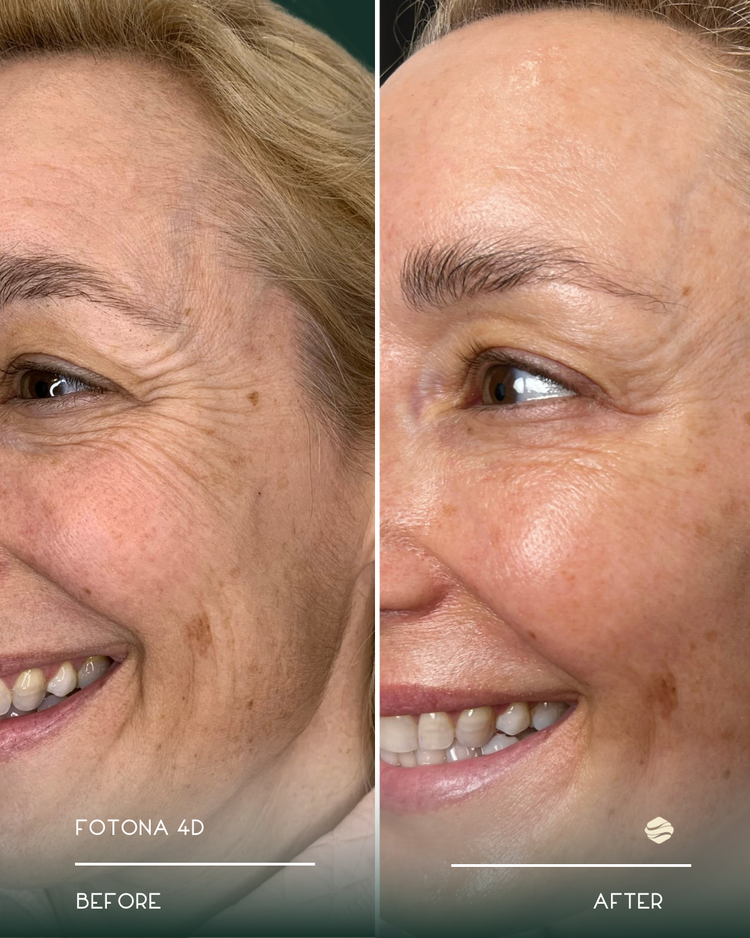 Fotona 4D Before and After 4