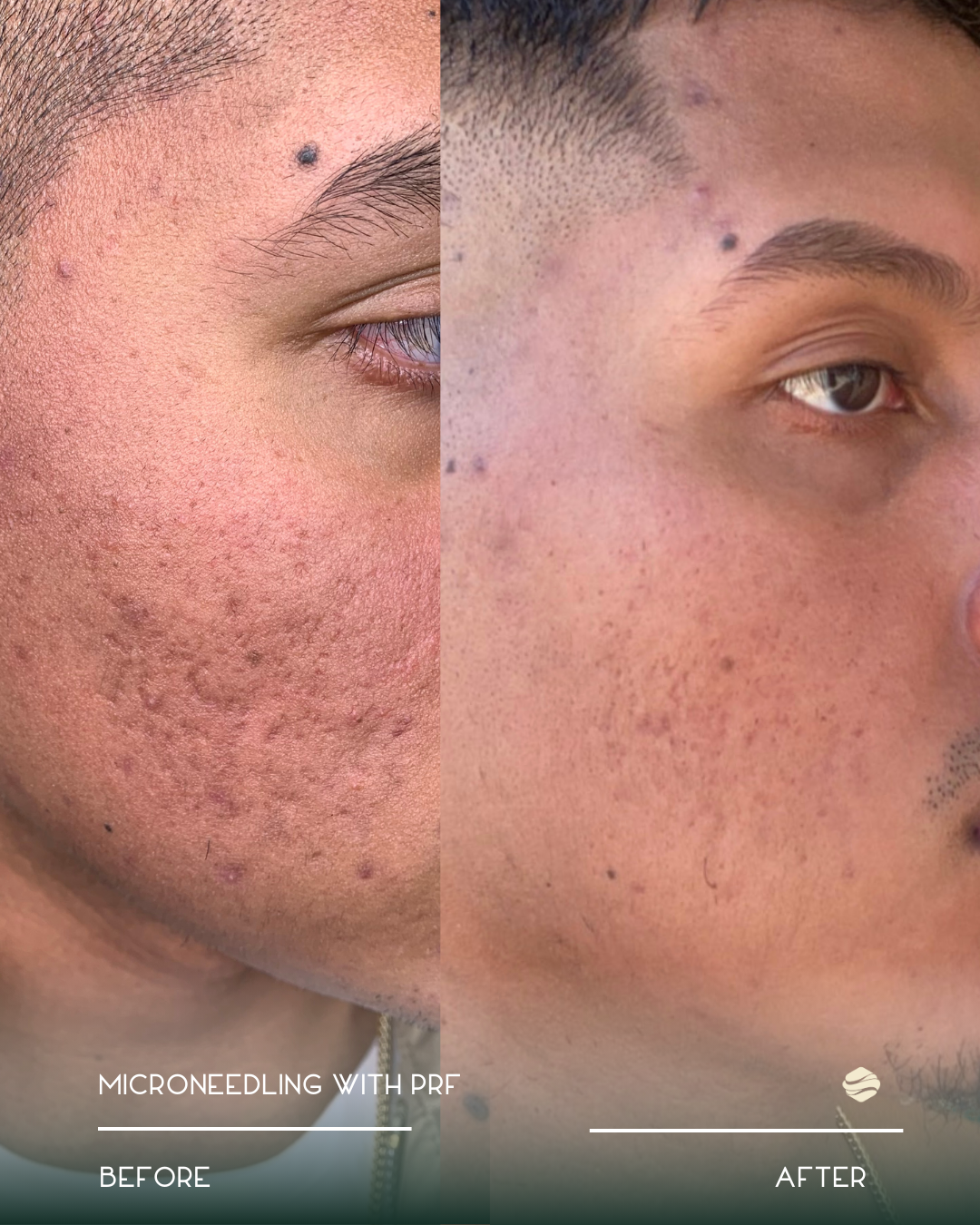 Side-by-side comparison of a person's face before and after microneedling with PRF, showing improved skin texture and reduced acne scars.