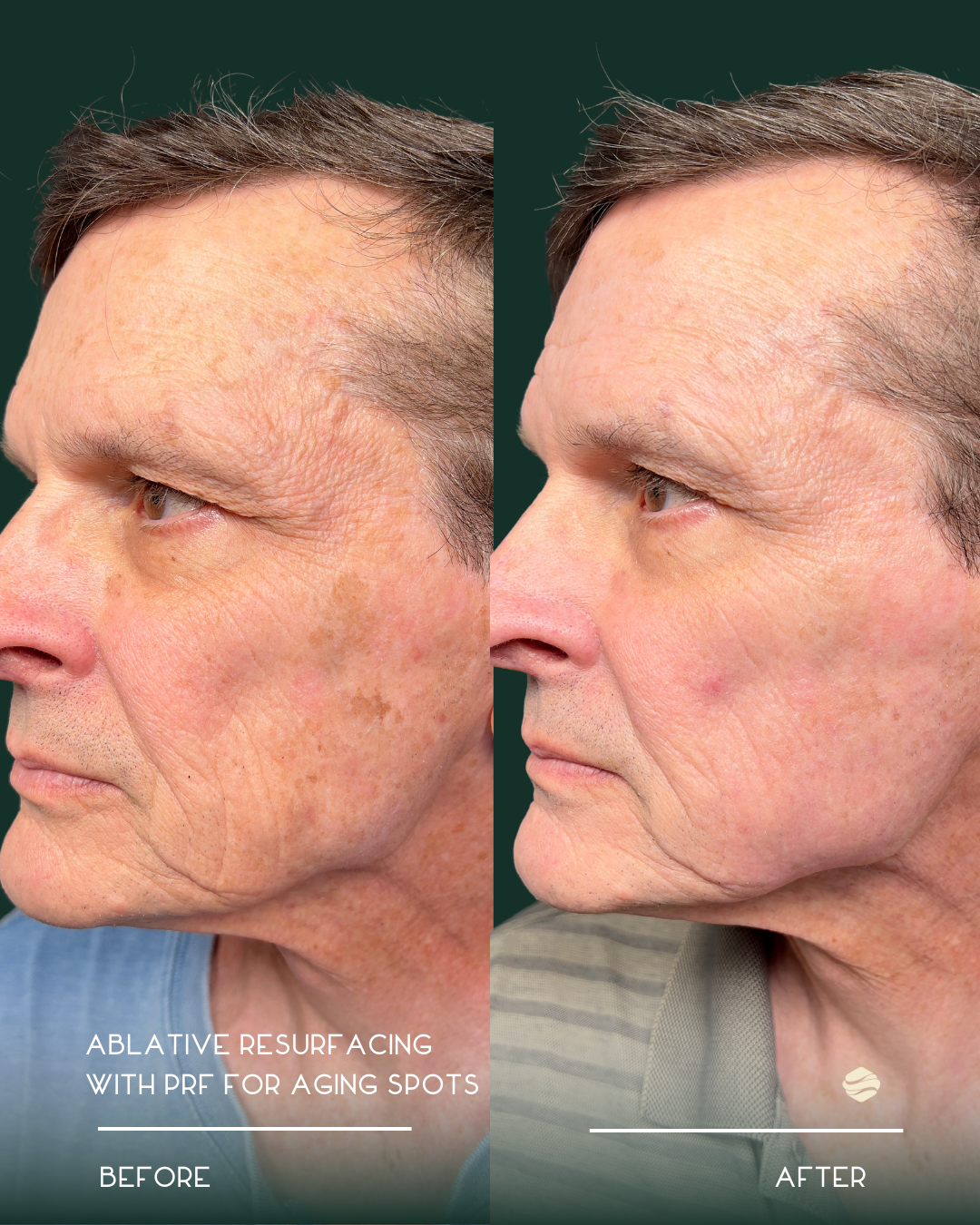 Side-by-side comparison of a man's face before and after ablative resurfacing treatment with PRF showing reduction in age spots and improved skin texture.