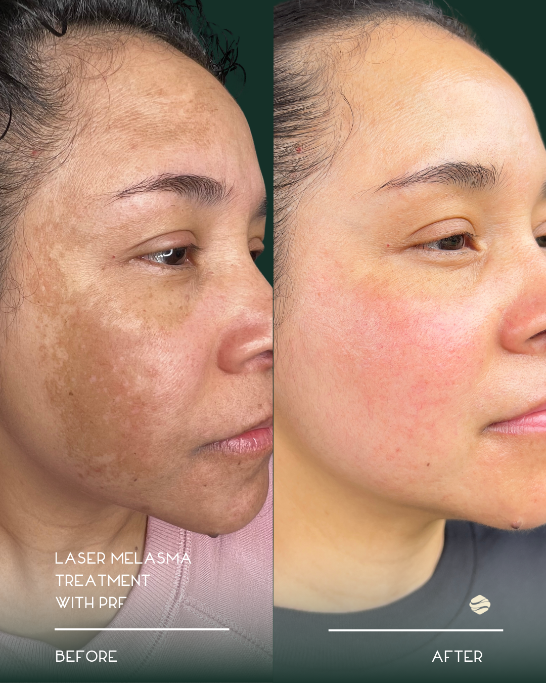 Side-by-side comparison of a woman's face showing improvement in skin condition after laser melasma treatment with PRF, with visible reduction in dark spots and hyperpigmentation.