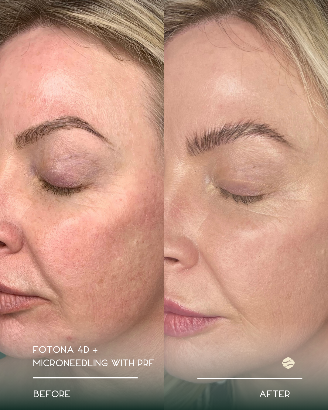 Side-by-side comparison of a woman's face before and after cosmetic treatment, showing improved skin texture and eyebrow enhancement.