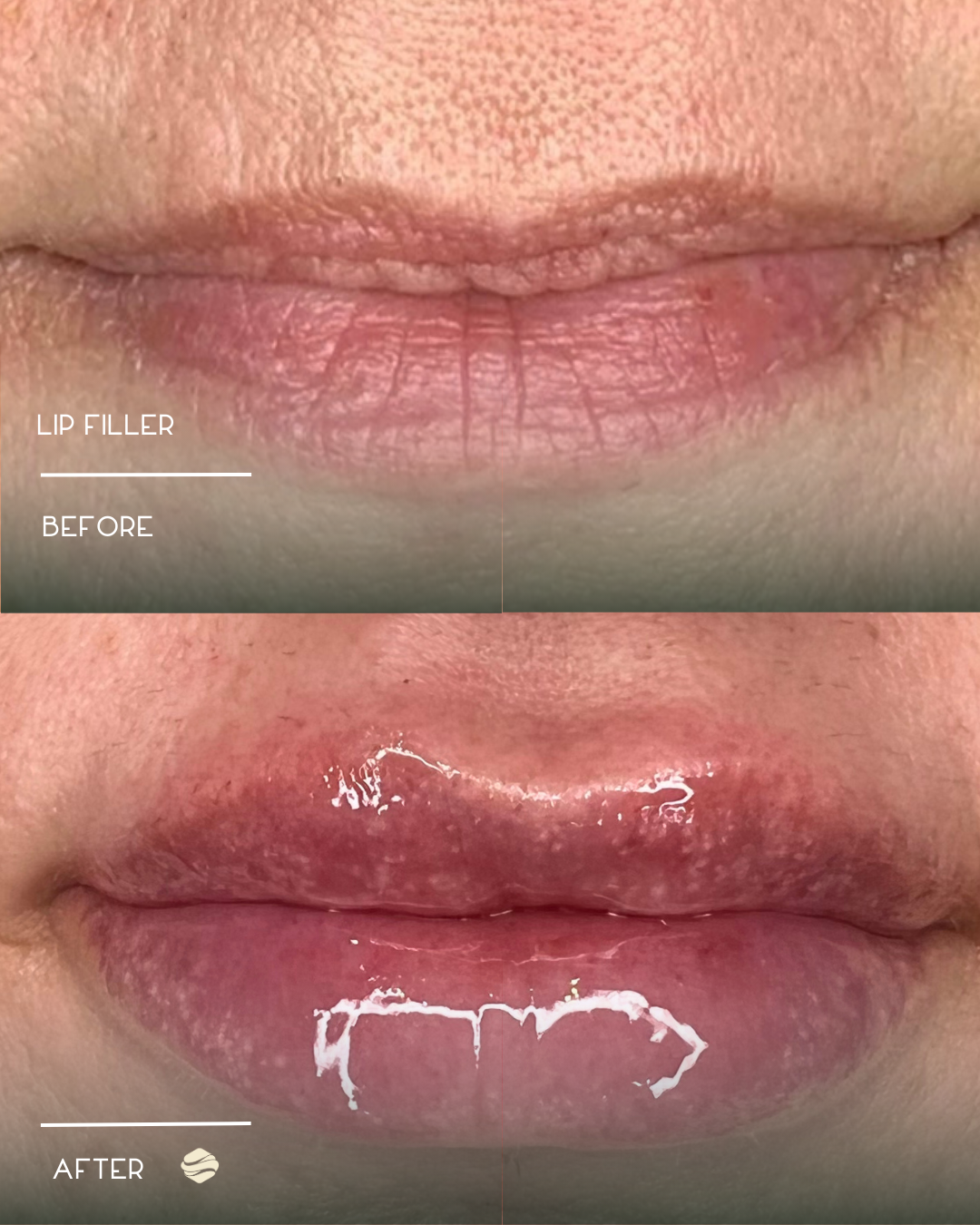 Close-up of lips before and after lip filler treatment showing improved volume and hydration, with the after lip also appearing with a glossy finish.
